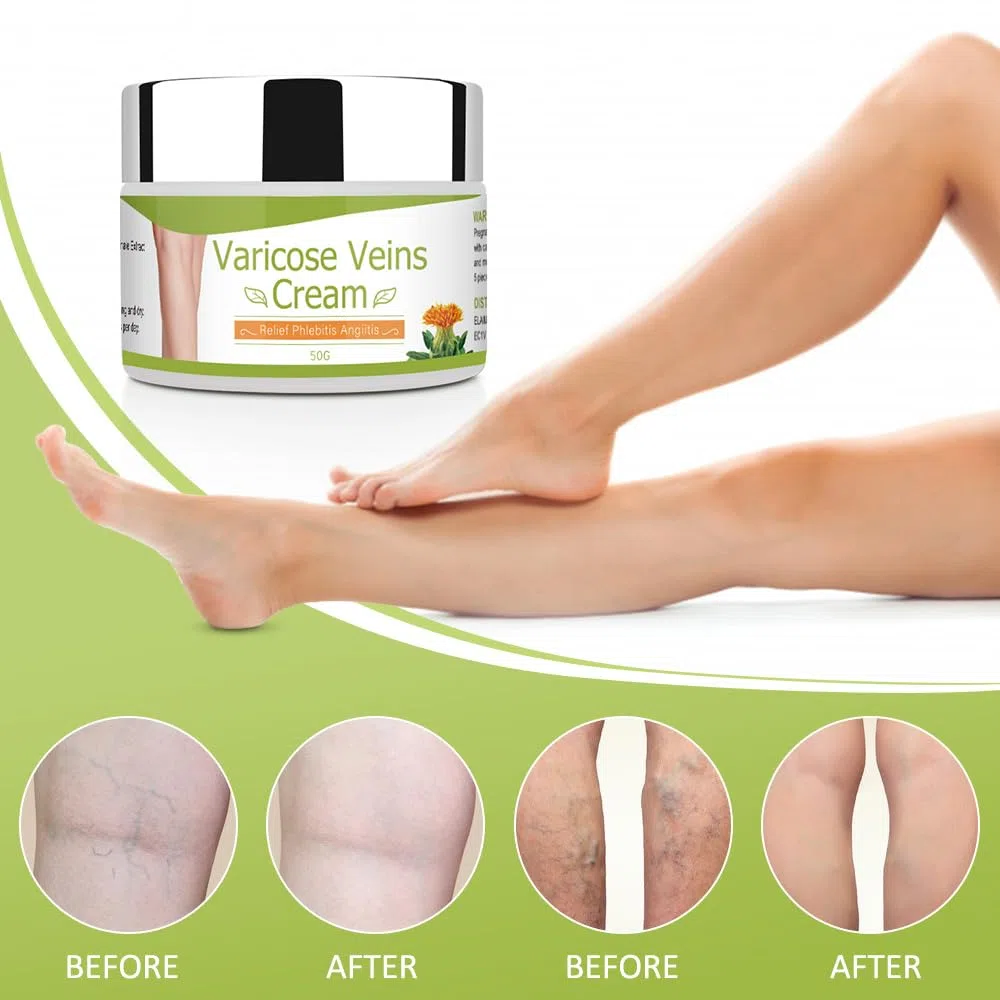 Crema para Varices 50G circulación sanguínea en las piernas, Crema para venas varicosas, alivio de flebitis, mejorar la inflamación de los vasos