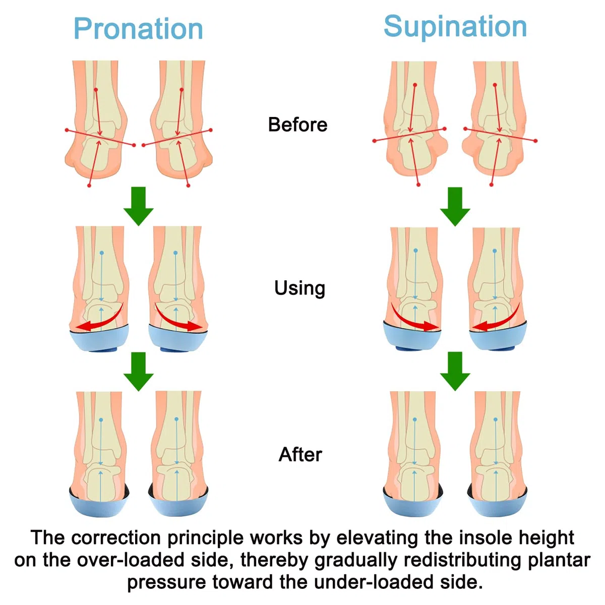 Endoto Plantillas Correctoras de Pronador y Supinador para Hombre Mujer Niños Infante, Insoles Ajustables para Supinación Pronación Over Supination y Pronation - XXXL