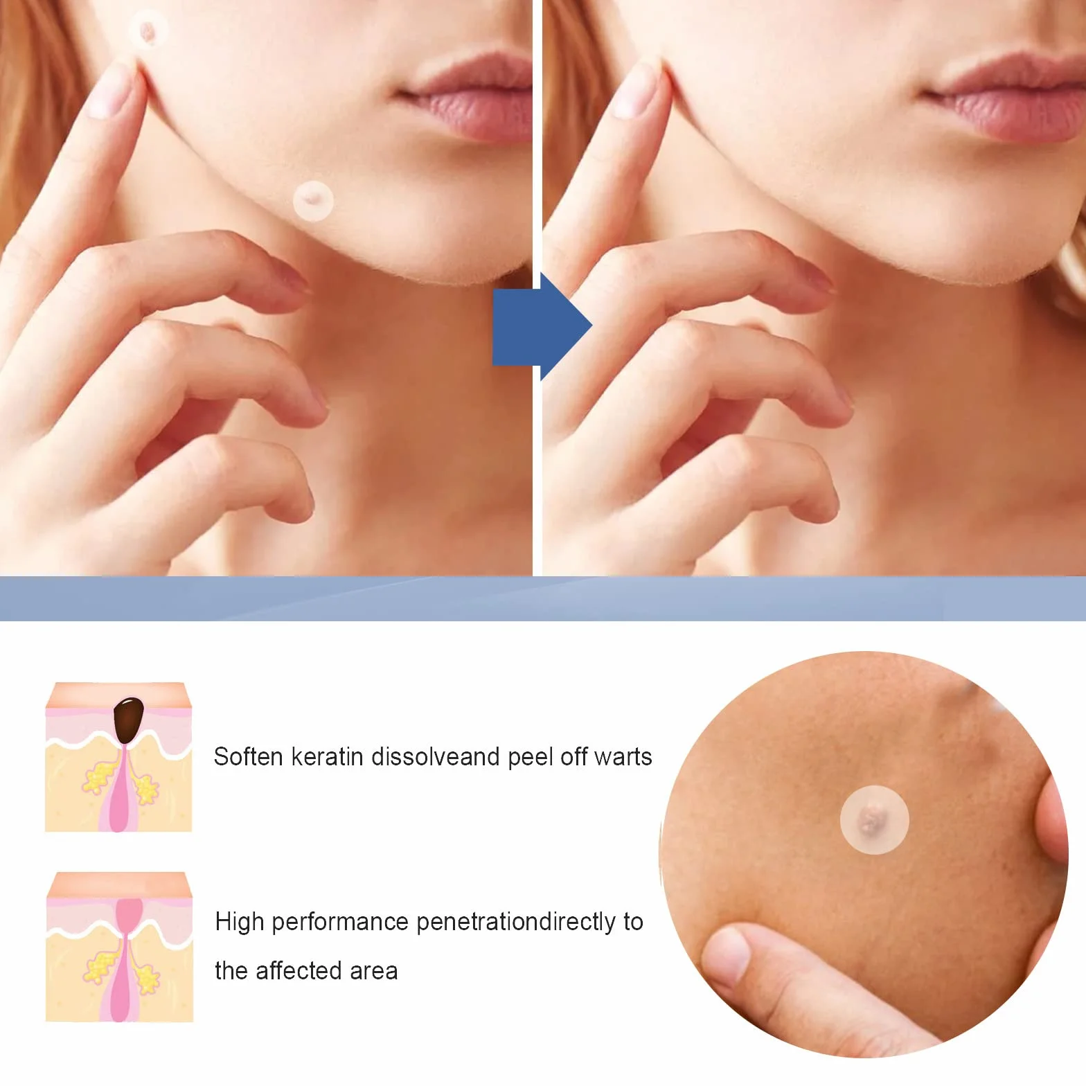 Wart and Mole Removal Patches,Parches Quita Verrugas Cuello y Cara,Producto de Verrugas,Skin Tag Removal Patches,Parches Quita Wart Cuello y Cara,para Mujer Hombre,144 Piezas
