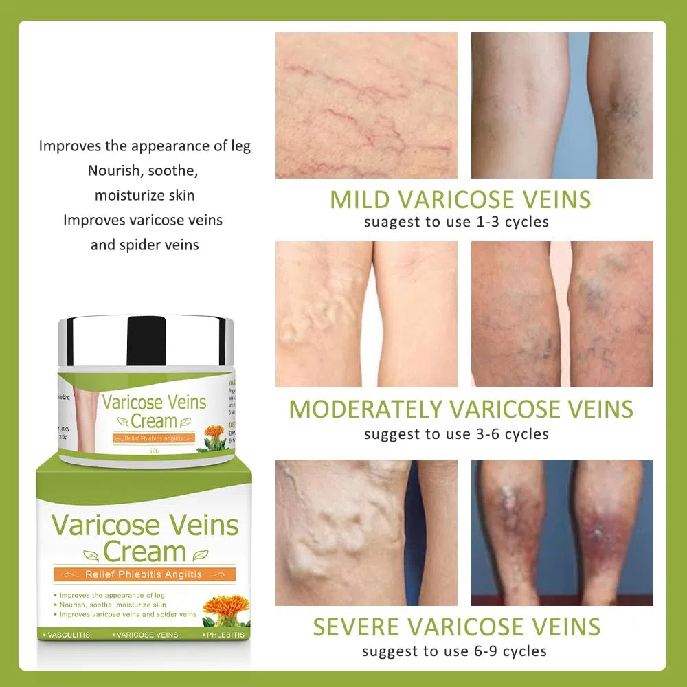 Crema para Varices 50G circulación sanguínea en las piernas, Crema para venas varicosas, alivio de flebitis, mejorar la inflamación de los vasos